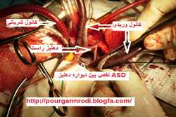 نقص دیواره بین دهلیزی(ASD)